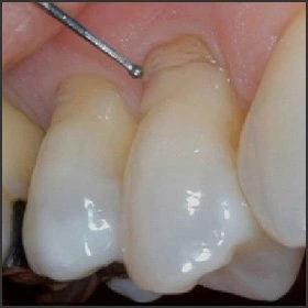 A History and Update of Fluoride Dentifrices