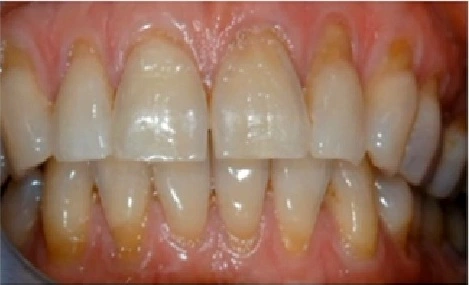 Photo showing young 30-year-old presenting with multiple types of wear.